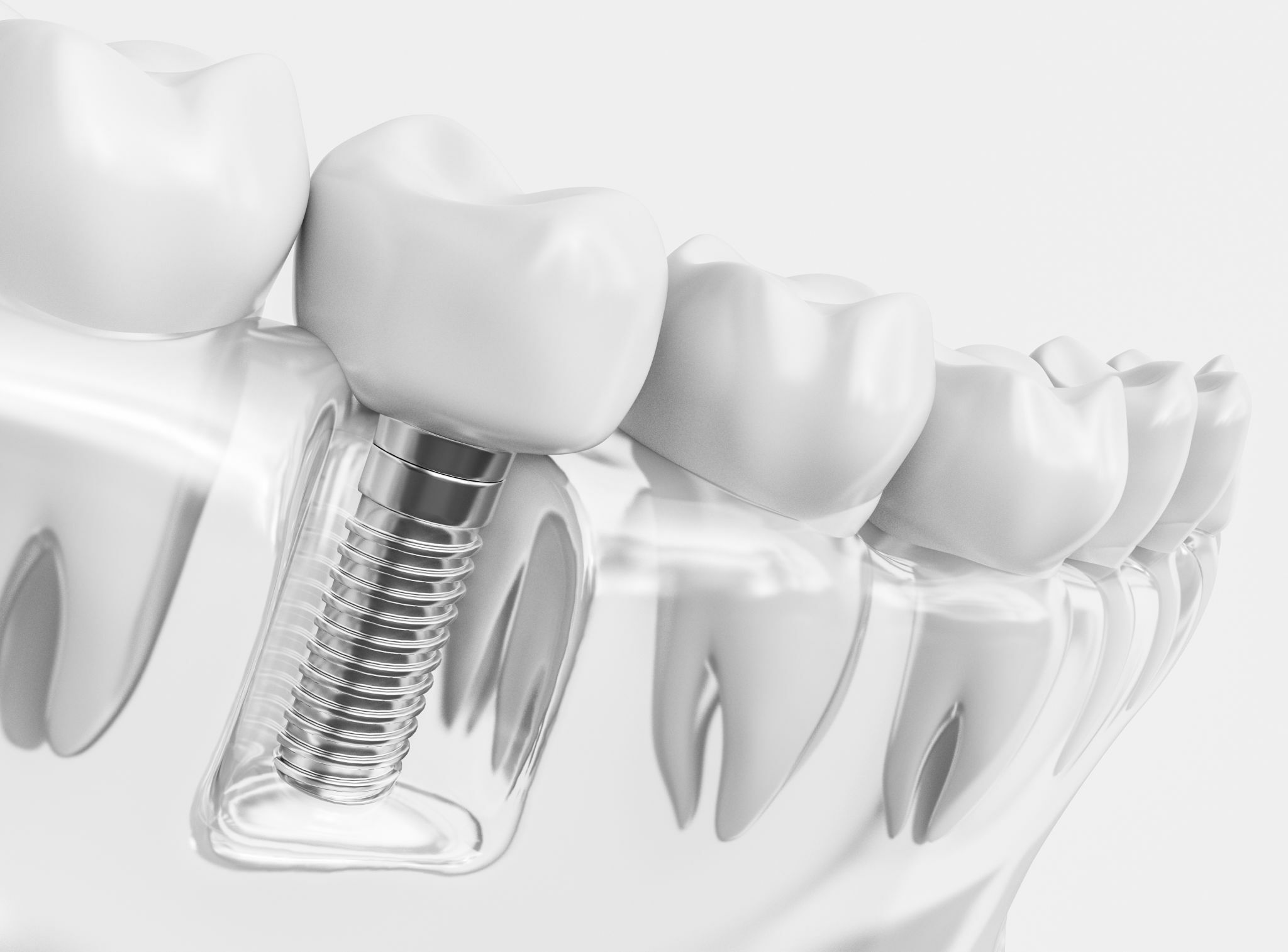 Dental Implants Aberdeen
