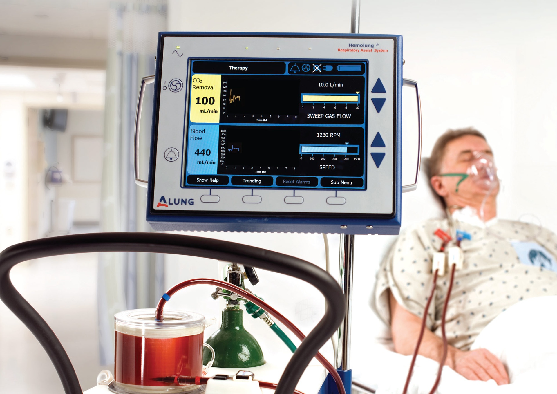 Extracorporeal Carbon Dioxide Removal (ECCO2R) Devices Market